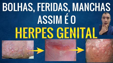 herpes no penis - bancos digitais no brasil